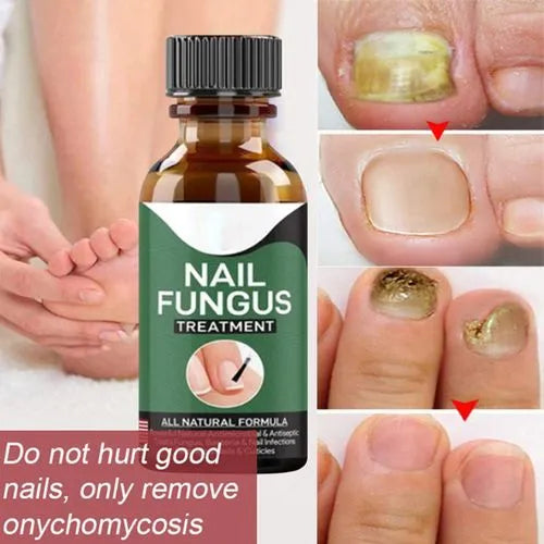 Nail Fungal Repair Serum