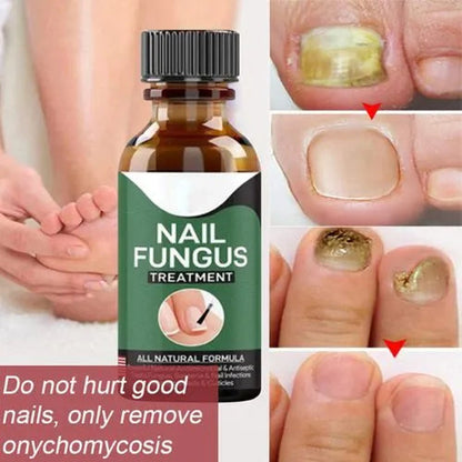 Nail Fungal Repair Serum