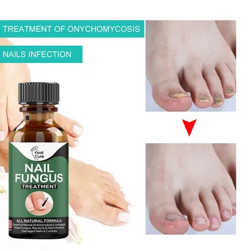 Nail Fungal Repair Serum